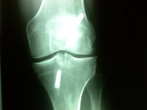 front image of left knee with titanium screws