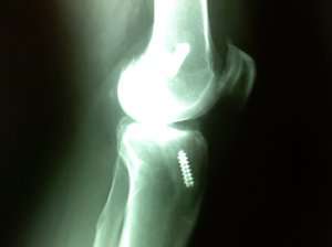 lateral view of left knee